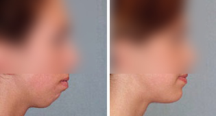 Chin Augmentation