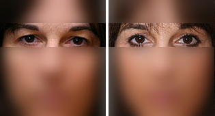 Blepharoplasty (eyelid surgery)